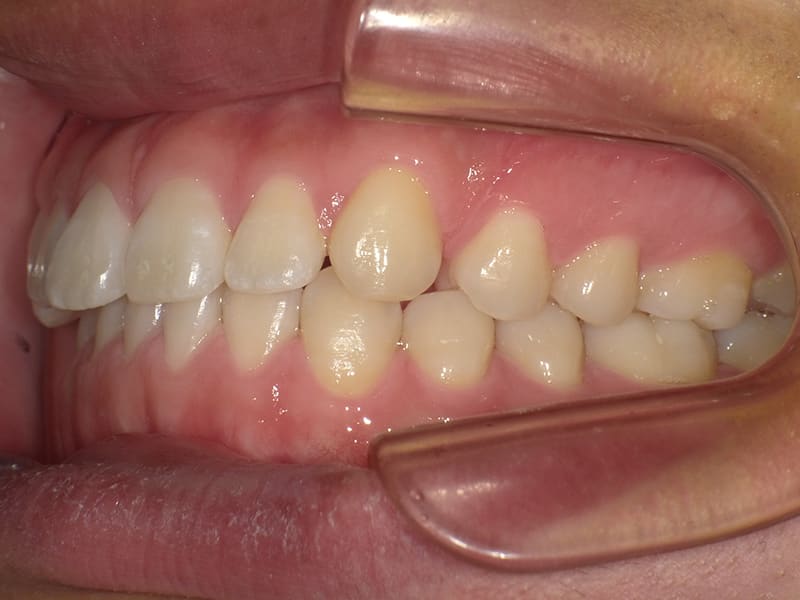 矯正症例 No.004 20代 / 空隙歯列・過蓋咬合の症例