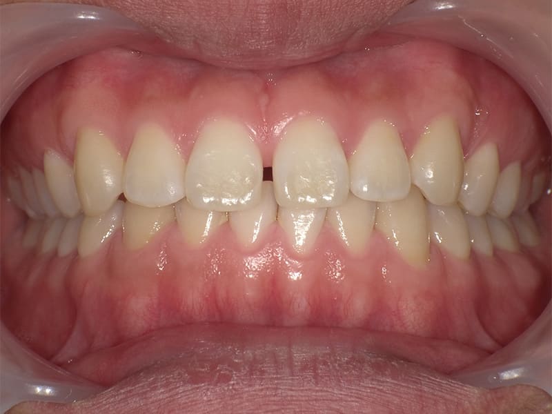 矯正症例 No.004 20代 / 空隙歯列・過蓋咬合の症例