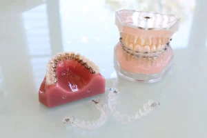 ワイヤー矯正とマウスピース矯正の違いを徹底比較｜治療できる症例・抜歯・仕上がりの差とは