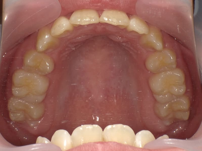 [No.001] 10代 / 叢生・上顎前突の症例・治療例 - 江口矯正歯科クリニック