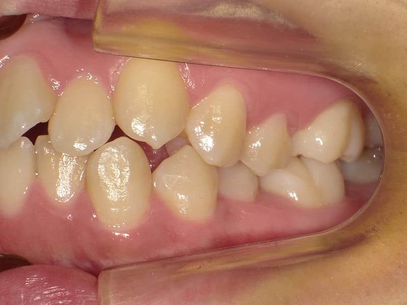 [No.001] 10代 / 叢生・上顎前突の症例・治療例 - 江口矯正歯科クリニック