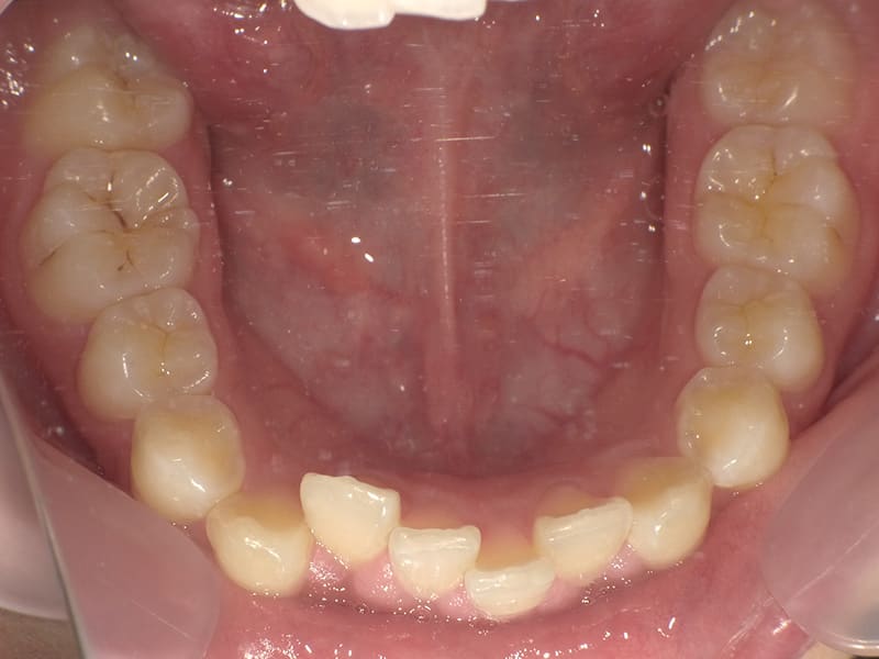 [No.003] 10代 / 叢生・交叉咬合の症例・治療例 - 江口矯正歯科クリニック