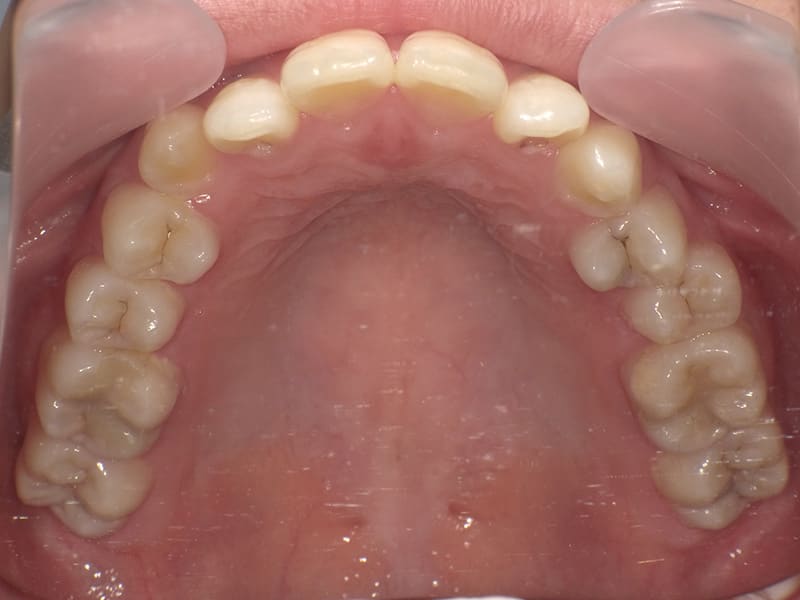 [No.005] 20代 / 上顎前突・開咬・叢生の症例・治療例 - 江口矯正歯科クリニック