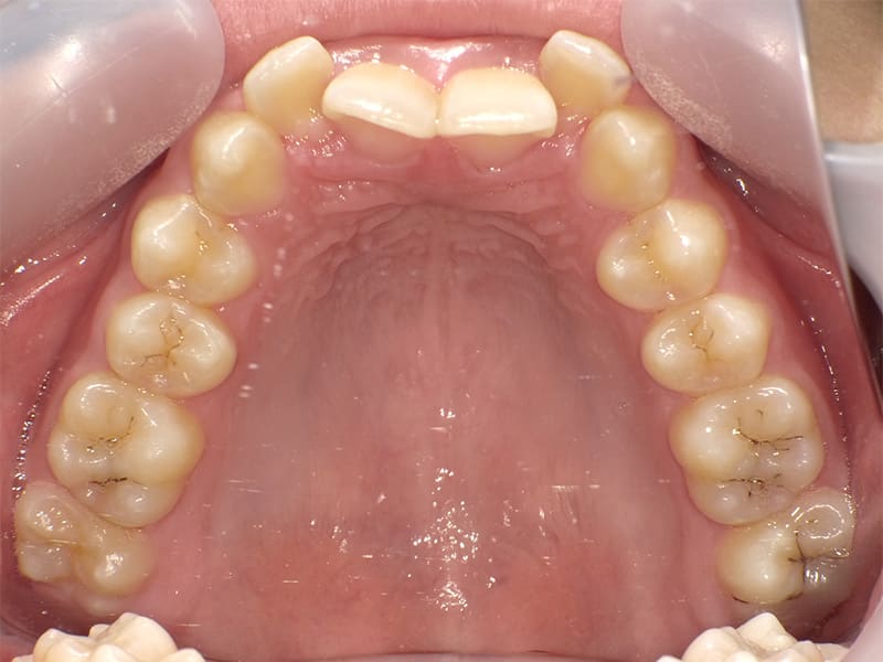 [No.008] 10代 / 叢生・上顎前突・過蓋咬合の症例・治療例 - 江口矯正歯科クリニック