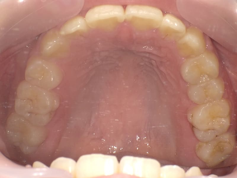 10歳未満 / 上顎の叢生（下顎前歯2本欠損・左上4埋伏）/ 症例・治療例 - 江口矯正歯科クリニック
