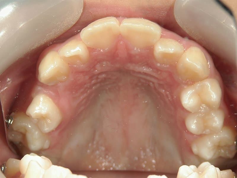 10歳未満 / 上顎の叢生（下顎前歯2本欠損・左上4埋伏）/ 症例・治療例 - 江口矯正歯科クリニック