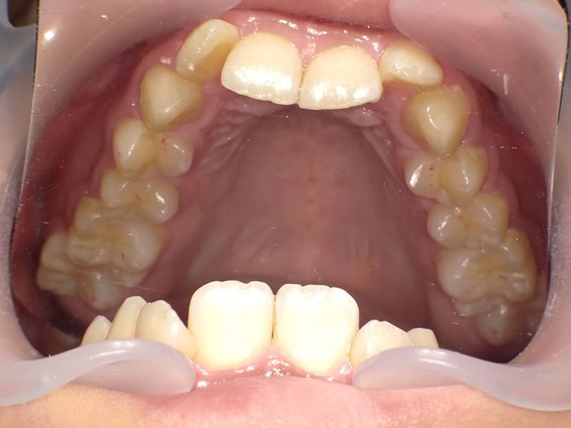 【No.010】10代 / 前歯の深咬み・側切歯の唇側転移・下顎前歯1本欠損