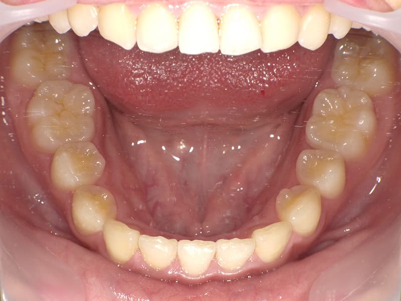 【No.010】10代 / 前歯の深咬み・側切歯の唇側転移・下顎前歯1本欠損