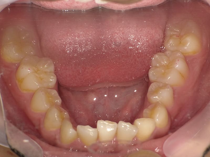 【No.010】10代 / 前歯の深咬み・側切歯の唇側転移・下顎前歯1本欠損