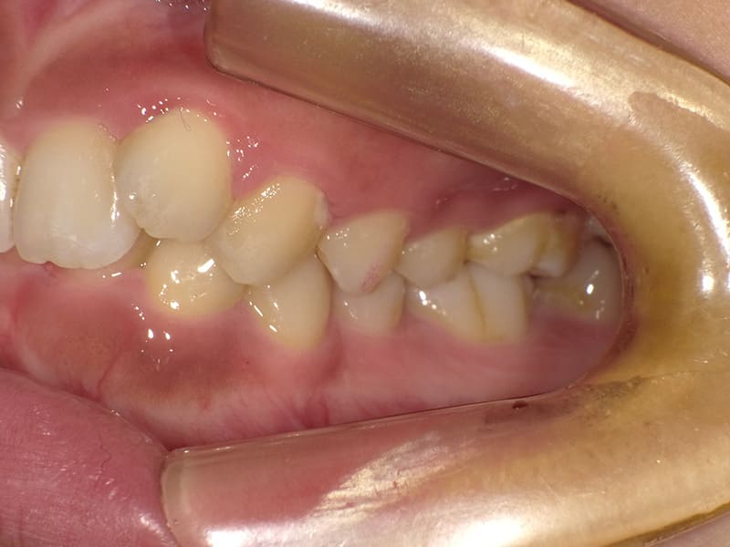 【No.010】10代 / 前歯の深咬み・側切歯の唇側転移・下顎前歯1本欠損