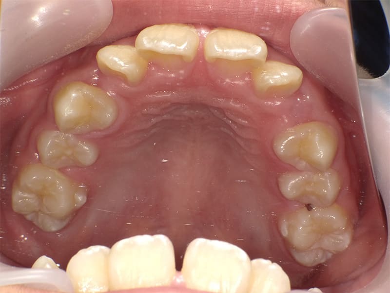 【No.012】前歯がガタガタで生えるスペースがないので将来の歯並びが心配 / 症例・治療例 - 江口矯正歯科クリニック