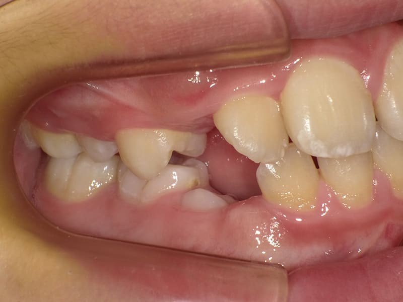 【No.012】前歯がガタガタで生えるスペースがないので将来の歯並びが心配 / 症例・治療例 - 江口矯正歯科クリニック