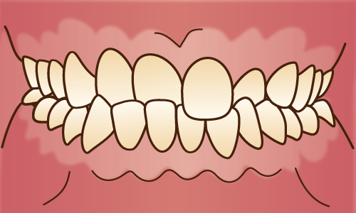 交叉咬合（クロスバイト）/ 不正咬合の種類 - 江口矯正歯科クリニック