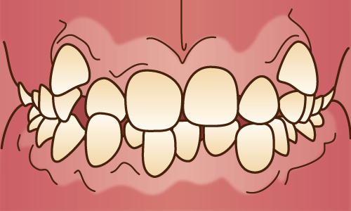 叢生（乱ぐい歯・八重歯）/ 不正咬合の種類 - 江口矯正歯科クリニック