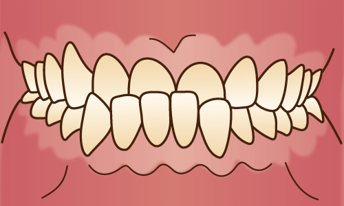 下顎前突（受け口） / 不正咬合の種類 - 江口矯正歯科クリニック過蓋咬合