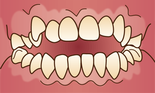 開咬（オープンバイト）/ 不正咬合の種類 - 江口矯正歯科クリニック