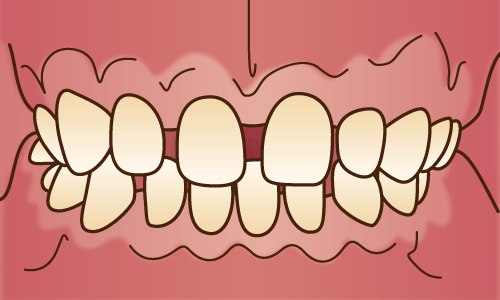 空隙歯列（すきっ歯）/ 不正咬合の種類 - 江口矯正歯科クリニック