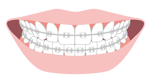 表側矯正（唇側矯正・ラビアル矯正） / 矯正装置について - 江口矯正歯科クリニック